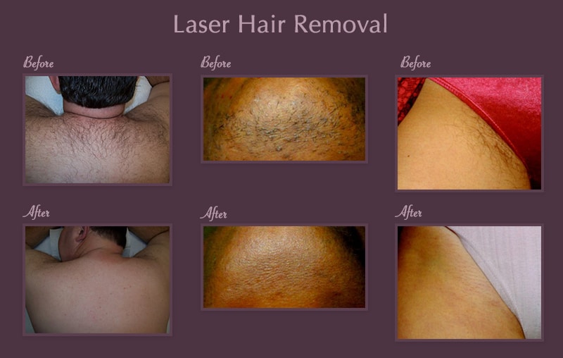 Raleigh Laser Hair Removal