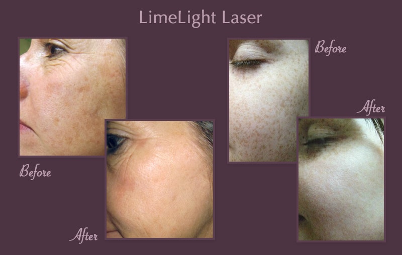 LimeLight Laser for Age Spots