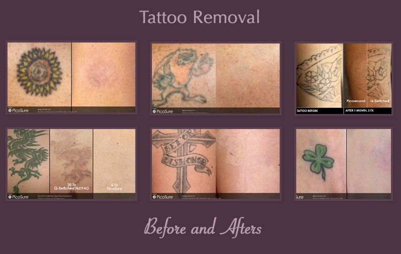PicoSure Tattoo Removal in Gainesville FL | Dermacare
