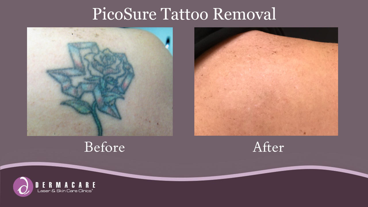 Before and After Tattoo Removal_Texas Rose